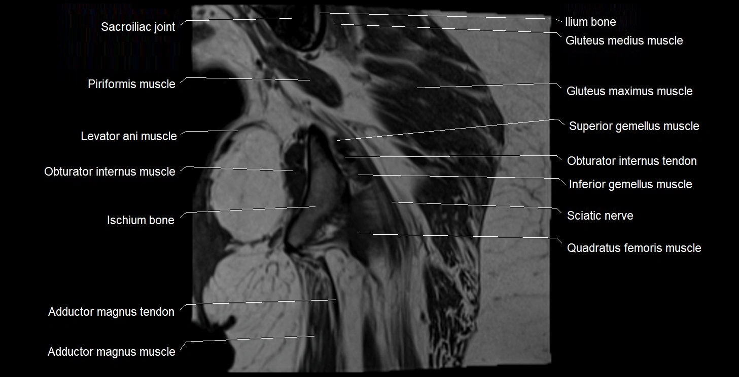 MRI Hip 3T coronal cross sectional anatomy image 49.webp
